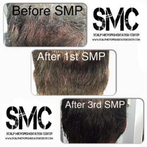 before and after of smp treatment in delhi