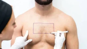 body hair transplant in delhi best clinic satya