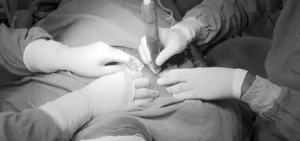 body hair transplant surgery in delhi at satya hair solution