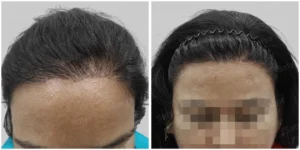 comparission result of female hair transplant
