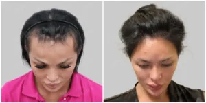 female hair transplant result