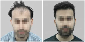 hair transplant ahmedabad before and after