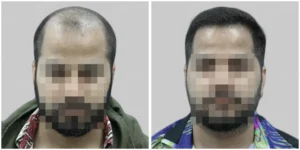 hair transplant done by best hair transplant clinic in bangalore - satya