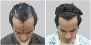 hair transplant done in mumbai before and after result of patient