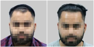 hair transplant in bangalore done by satya before and after