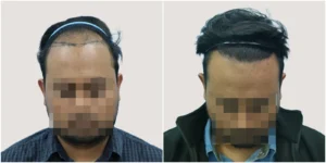 hair transplant in chennai before and after