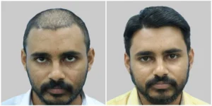 hair transplant in delhi ncr before and after result of men