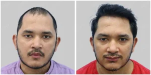 hair transplant in gurgaon before and after