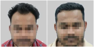 hair transplant in hyderabad brfore and after
