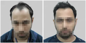 hair transplant in indore before and after of patient
