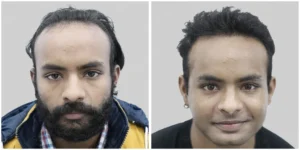 hair transplant in kolkata befor and after