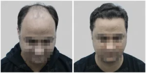 hair transplant in mumbai before after