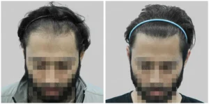 hair transplant in nagpur before and after result of satya hair solution
