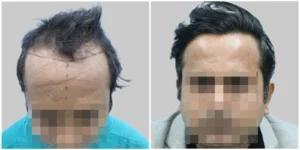 hair transplant in pune before and after