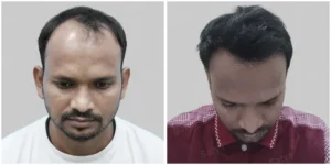 hair transplant inb pune result