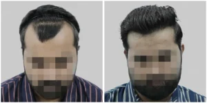 hair transplant result of gurgaon clinic satya hair solution