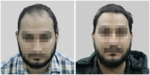jaipur hair transplant before and after of patient
