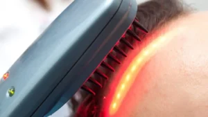 laser comb therapy in delhi