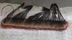 long hair transplant surgery in delhi at satya hair solution