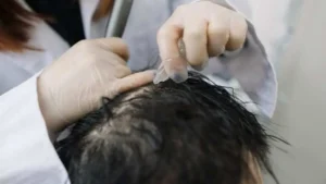 mesotherapy in delhi