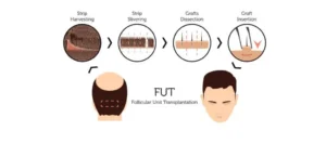 procedure of fut hair transplant