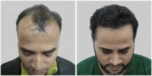 result of hair transplant in ahmedabad