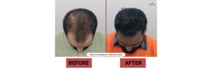 DHI vs FUE Hair Transplant