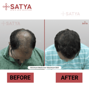 FUE vs FUT Hair Transplant