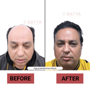 Hair Transplant Cost India