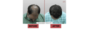 FUE vs FUT Hair Transplant