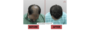 Hair Transplant Cost Per Graft in India