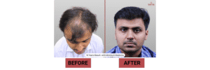 Hair Transplant Cost Per Graft in India