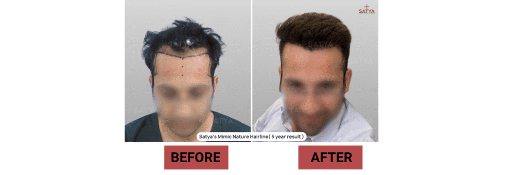 Top Rated Hair Transplant Surgeons in India