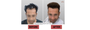 Top Rated Hair Transplant Surgeons in India – Trusted Experts at Satya Hair Solution