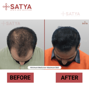 FUE vs FUT Hair Transplant