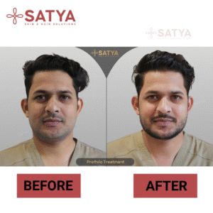 Beard Transplant Cost Delhi