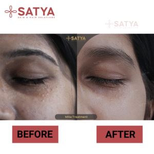 Eyebrow Transplant Cost India