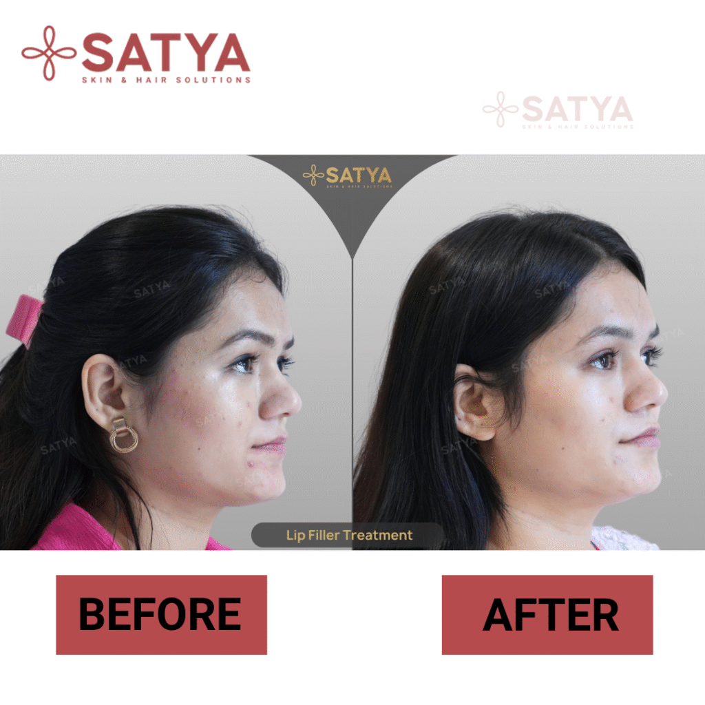 Eyebrow Transplant Cost India