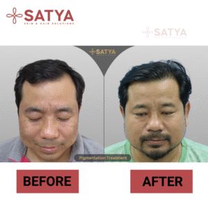 Beard Transplant Cost Delhi