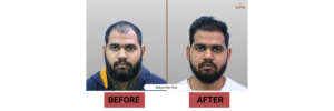 FUE Hair Transplant Cost in India – Complete Guide by Satya Hair Solution