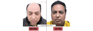 Hair Transplant Cost India