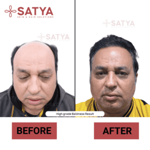 Hair Transplant Cost India