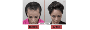 Female Hair Transplant in India