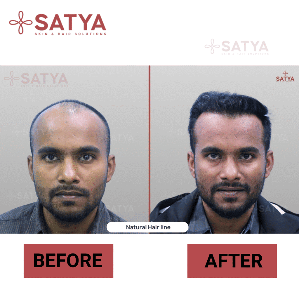 Hair Transplant Cost Per Graft India