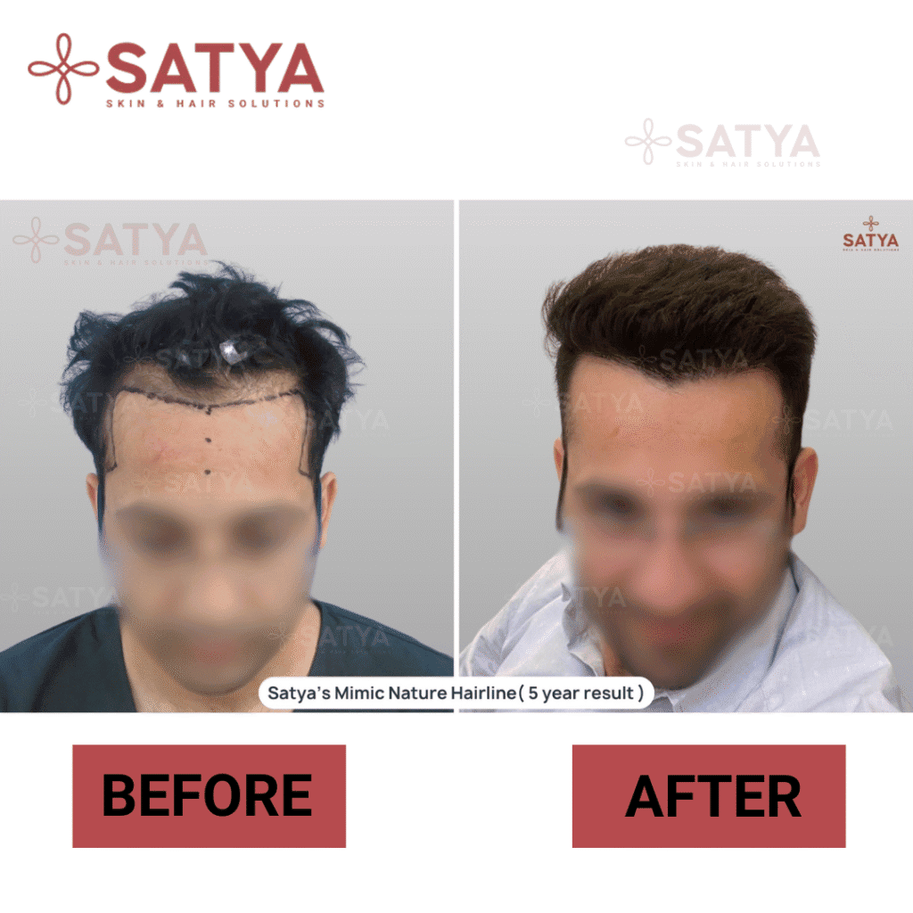 Hair Transplant Cost Per Graft India