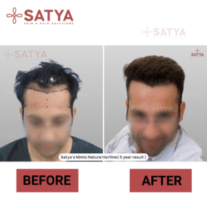 Hair Transplant Cost Per Graft India