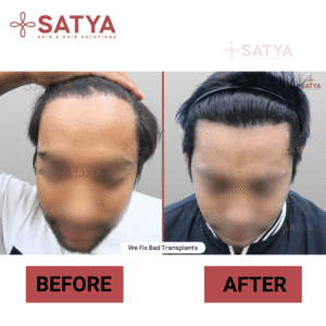 DHI vs FUE Difference