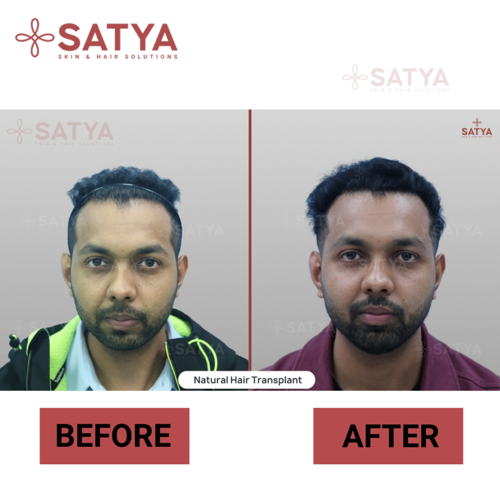 Top Rated Hair Transplant Surgeons India