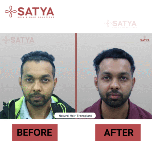 Top Rated Hair Transplant Surgeons India