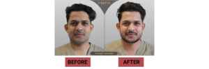 Beard Transplant Cost in Delhi
